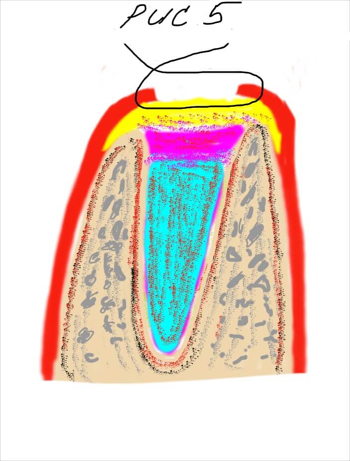Презервация лунки после удаления зуба