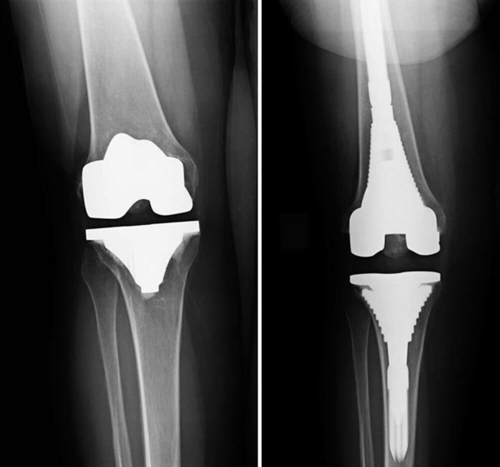 Костно-пластические материалы и методы замещения дефектов кости для тотального эндопротезирования коленного сустава