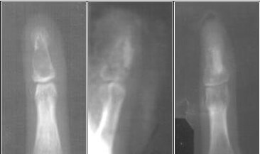Первый опыт лечения костных кист фаланг пальцев кисти, с применением биокомпозиционного остеопластического материала Остеоматрикс