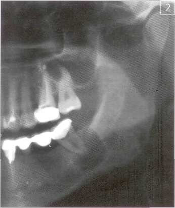 Хирургическое лечение радикулярных кист челюстных костей с использованием биокомпозиционного материала Остеоматрикс