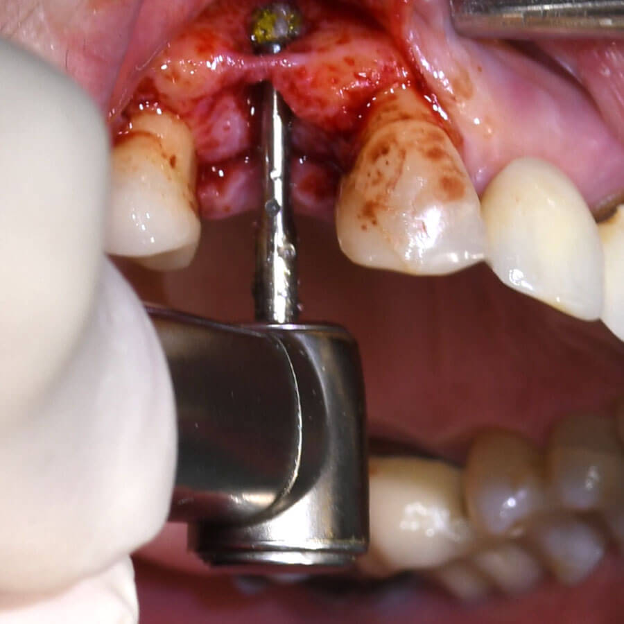 Имплантация зубов с немедленной нагрузкой: факторы риска