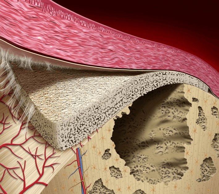 Стоматологические мембраны для направленной регенерации кости