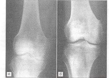 Применение в клинике костной патологии ЦИТО биокомпозиционного материала Остеоматрикс