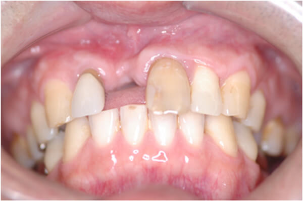 Профилактика атрофии альвеолярного отростка челюсти после удаления зуба: применение современных технологий и остеопластических материалов
