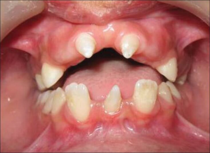 Лечение дефектов зубных рядов, осложненных зубочелюстными деформациями