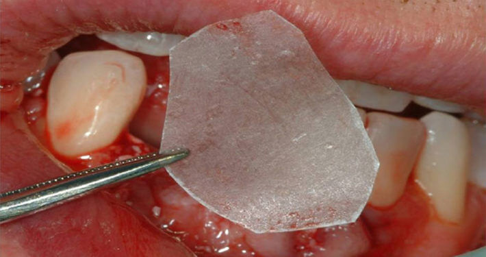Коллагеносодержащий материал для стоматологии