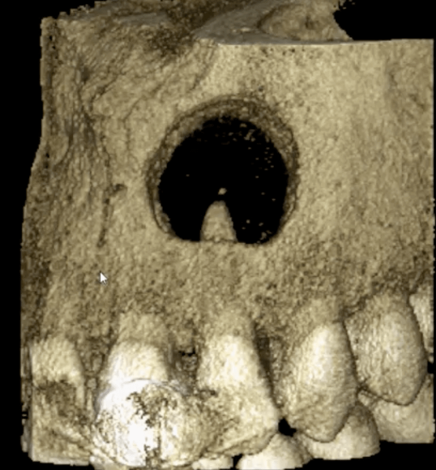 Инновационные методы лечения костных дефектов челюсти, образовавшихся в результате удаления радикулярных кист