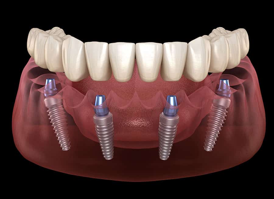 Хирургические методы подготовки челюстей к дентальной имплантации