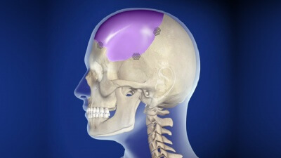 Complex skull defects reconstruction with САD/САМ titanium and polyetheretherketone (PEEK) implants