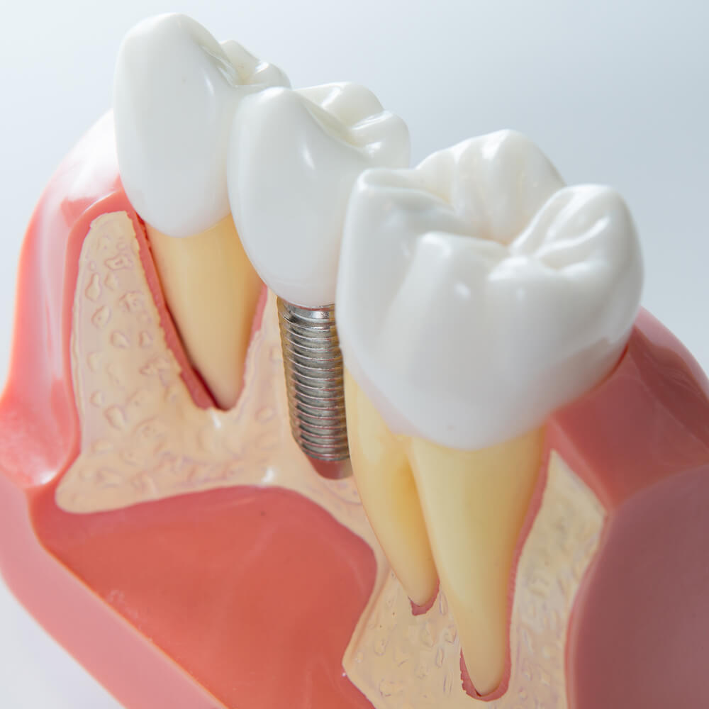 Заменители костной ткани для стоматологии: обзор материалов