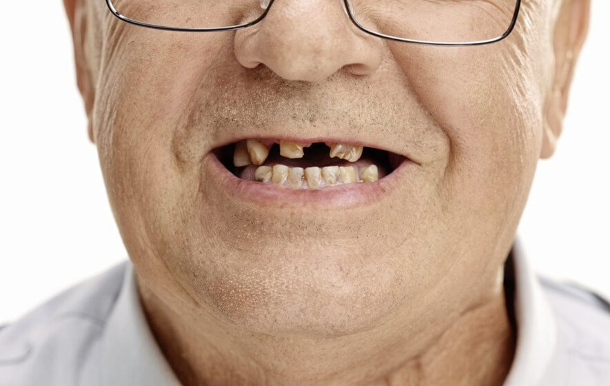 Влияние частичной потери зубов на здоровье ротовой полости