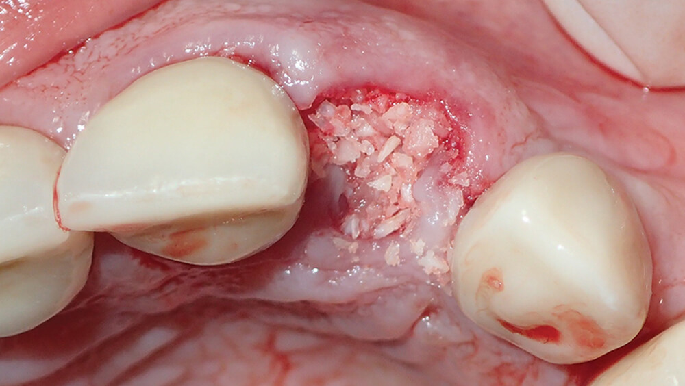 Выбор костно-пластических материалов для стоматологии