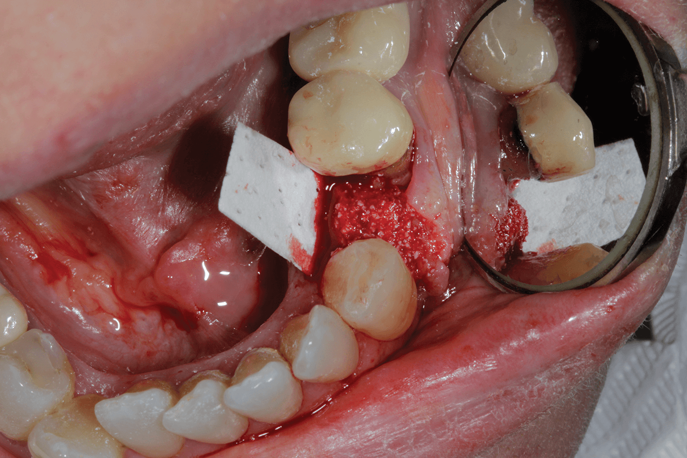 Мембраны в хирургической стоматологии: больше, чем барьерный эффект