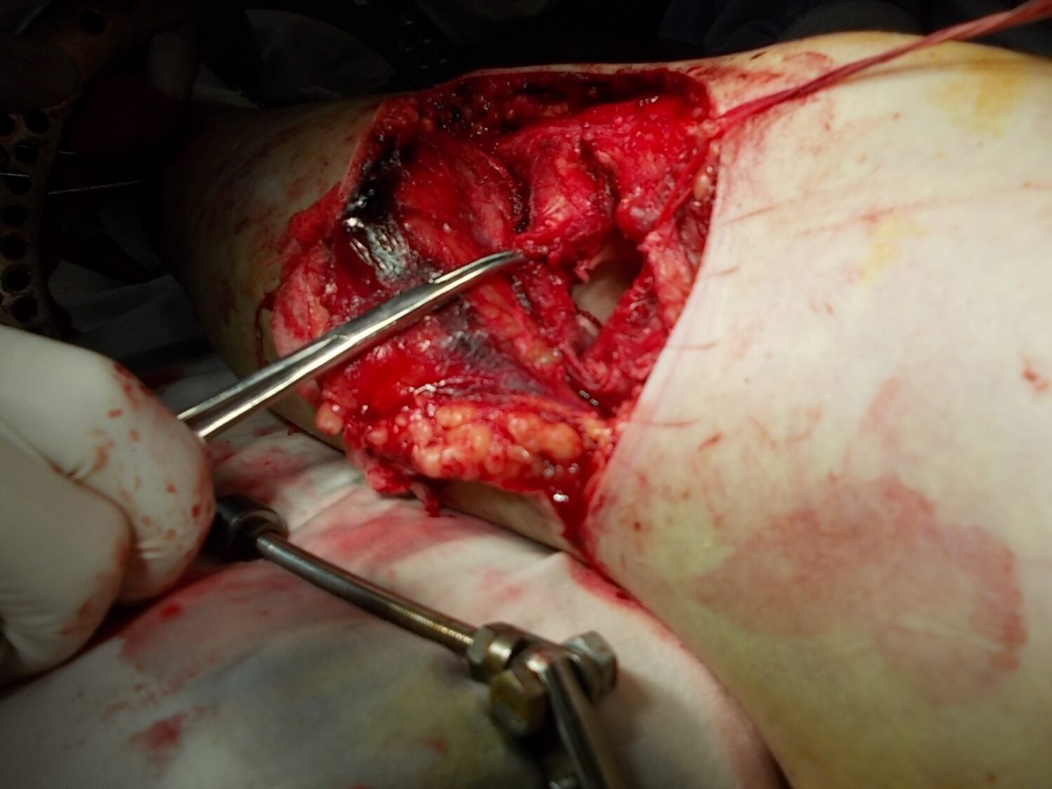 Использование материала Остеоматрикс при импрессионном оскольчатом переломе наружного мыщелка большеберцовой кости по типу Schatzker II