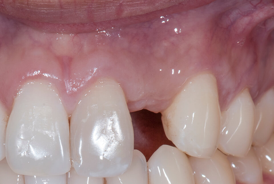 Остеопластика в стоматологии применяется при резорбции альвеолярного отростка после экстракции зуба