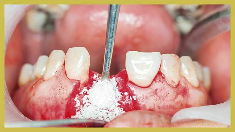 Ксеноматериалы для костной пластики (Остеоматрикс, Биоматрикс) дают великолепные в стоматологии, а также продолжают активно исследоваться в ортопедической хирургии.