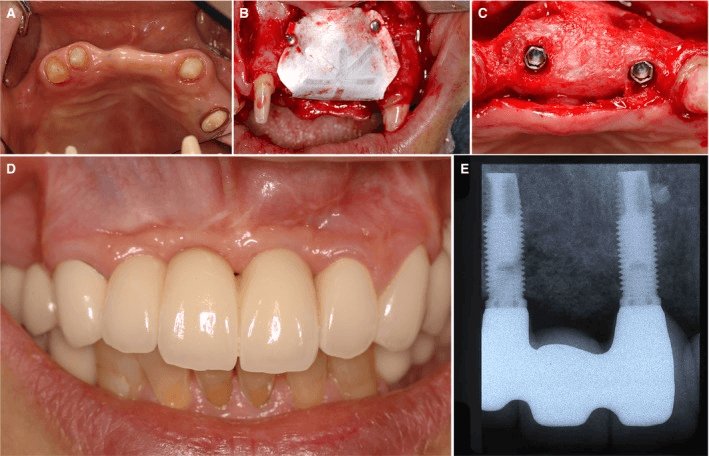 Горизонтальная аугментация методом НРК с помощью стоматологической мембраны из е-ПТФЭ