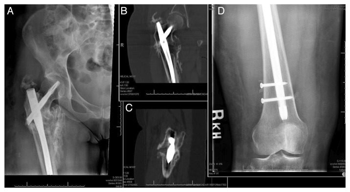 Пример использования костного материала для лечения перелома бедра