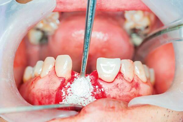 Заменители костной ткани применяют для презервации лунки после экстракции зуба