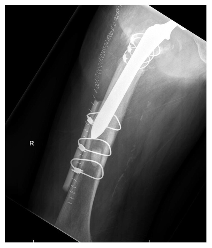 Использование аллогенного костного материала при перипротезном переломе бедра