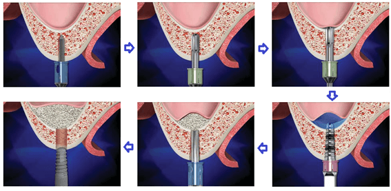Конкретная методика проведения процедуры зависит от многих факторов, и в первую очередь от первоначальной высоты костной стенки в проекции верхнечелюстных синусов