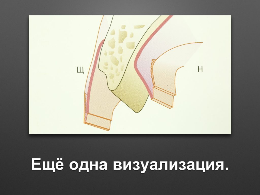 Увеличение ширины. Альвеолярный бугорок. Ширина альвеолярного гребня. Увеличение ширины альвеолярного отростка.